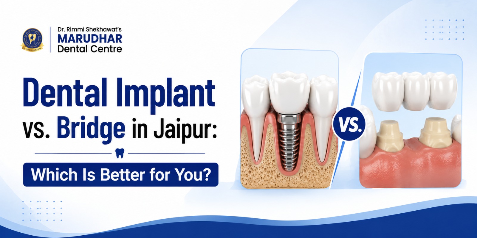 Dental Implant vs Bridge treatment comparison in Jaipur